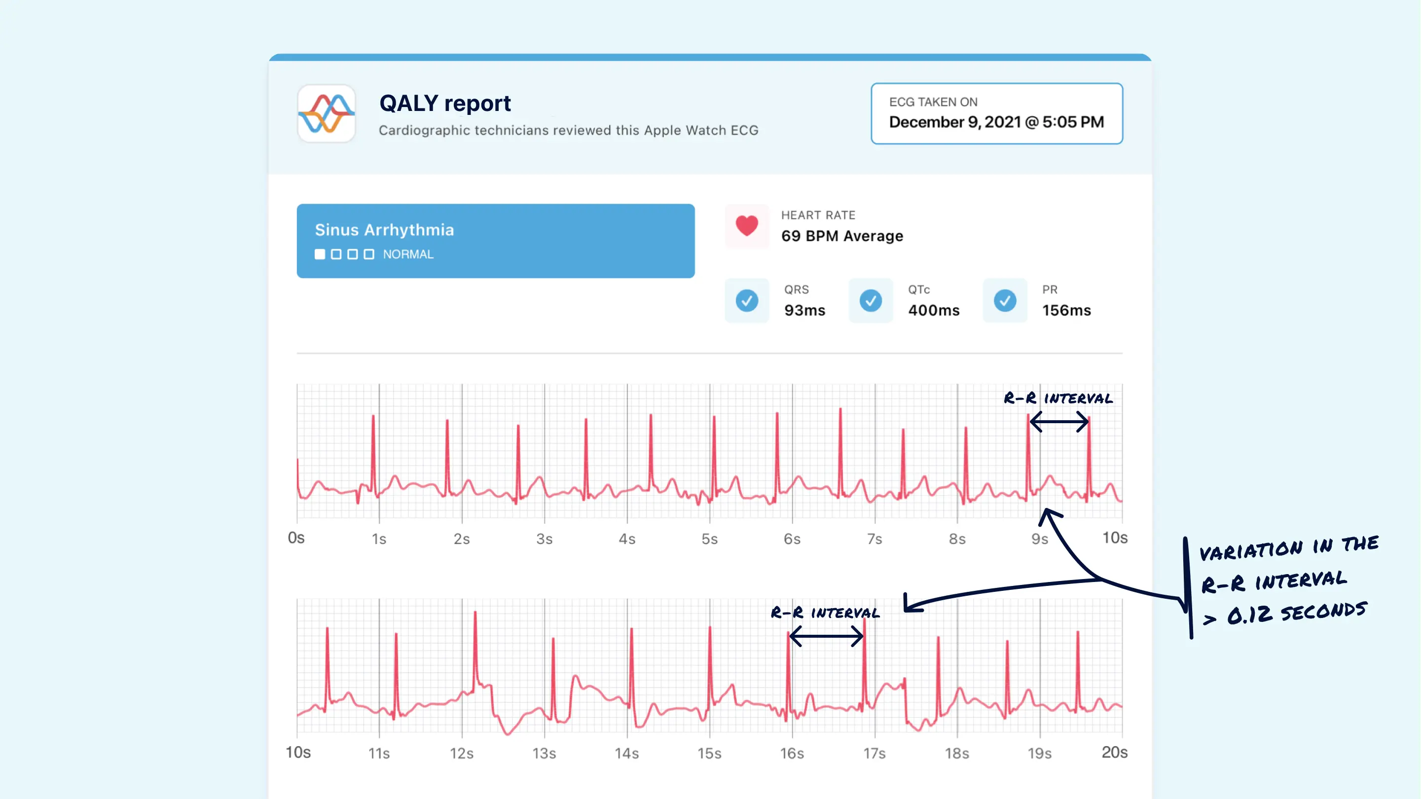 What Sinus Arrhythmia Looks Like on Your Watch ECG Qaly